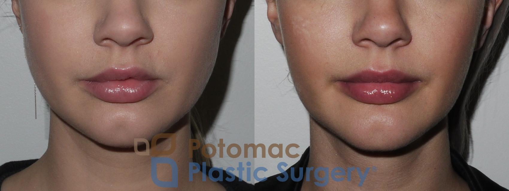 Before & After Neck Lift Case 189 Front View in Washington, DC