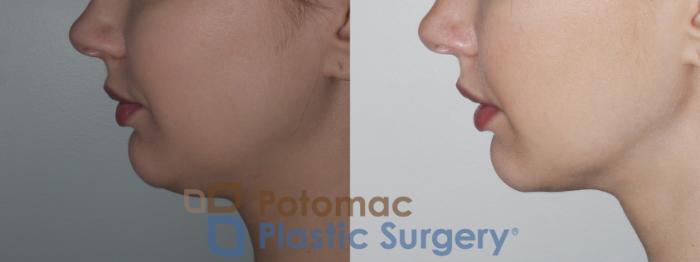 Before & After Facial Sculpting Case 189 Left Side View in Washington, DC