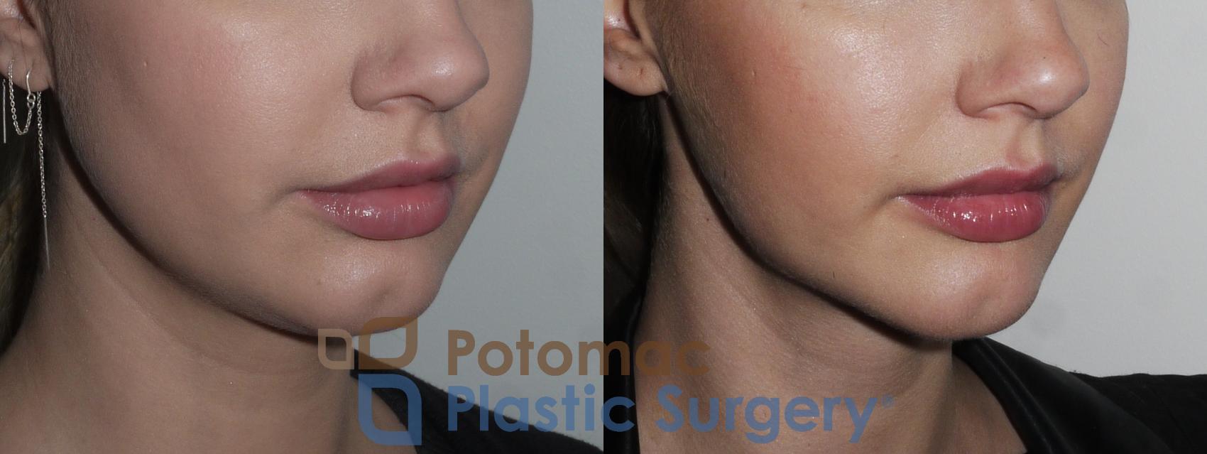 Before & After Neck Lift Case 189 Right Oblique View in Washington, DC