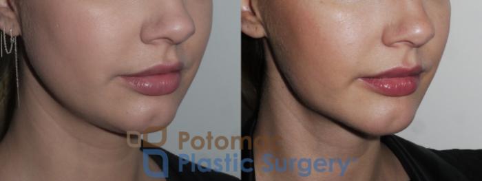Before & After Liposuction Case 189 Right Oblique View in Washington DC & Arlington , DC