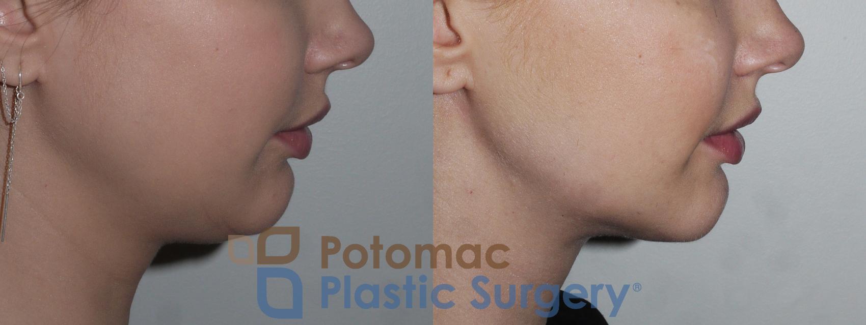 Before & After Neck Lift Case 189 Right Side View in Washington, DC