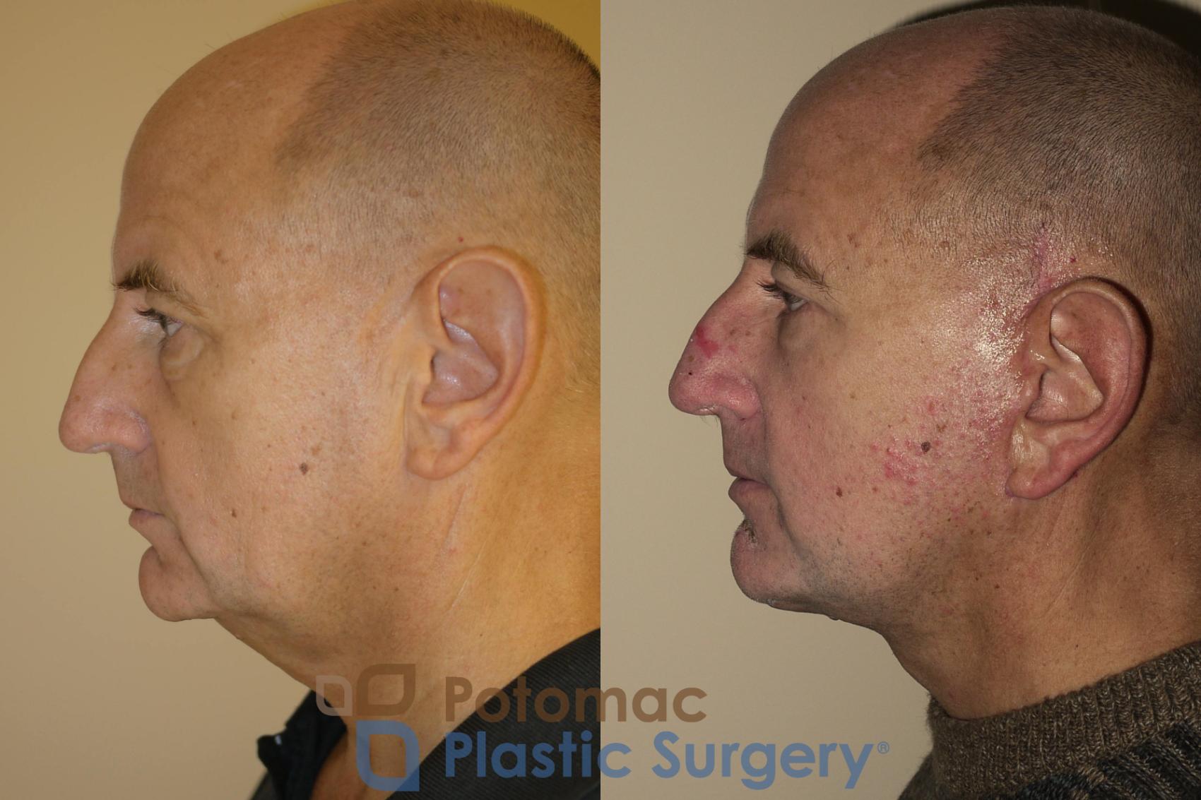 Before & After Skin Care Case 23 Left Side View in Washington DC & Arlington , DC