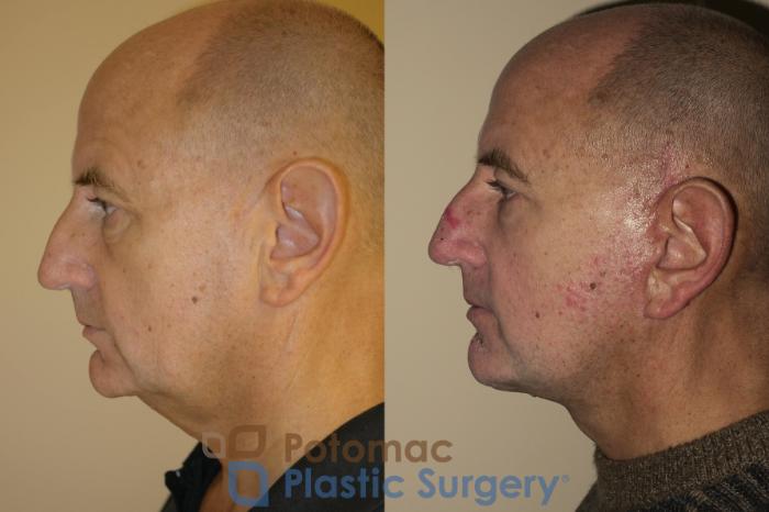 Before & After Neck Lift Case 23 Left Side View in Washington, DC