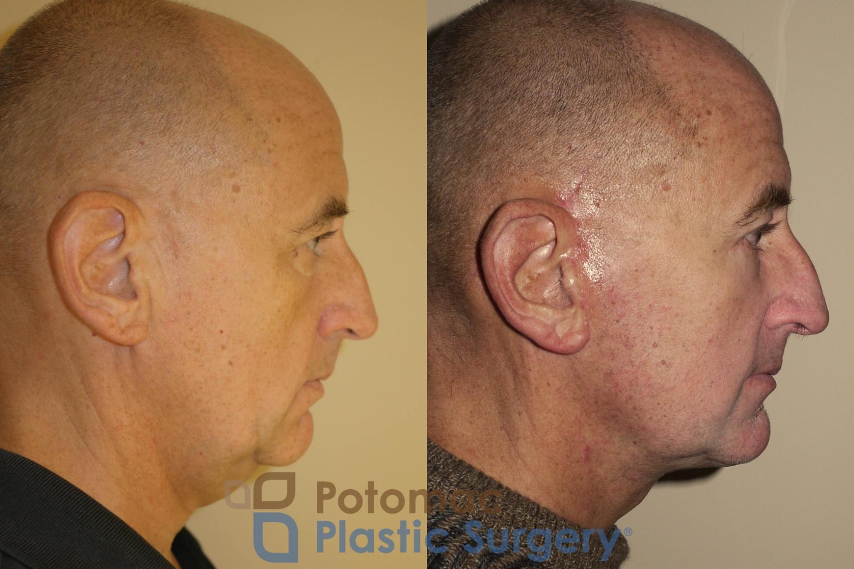 Before & After Blepharoplasty Case 23 Right Side View in Washington DC & Arlington , DC