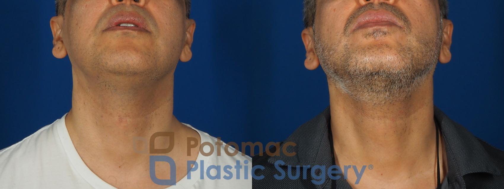 Before & After Neck Lift Case 238 Bottom View in Washington, DC