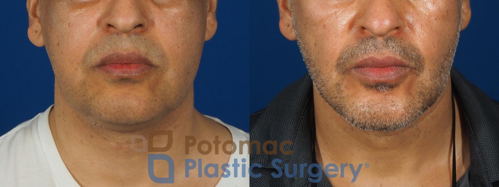 Before & After Buccal Fat Reduction Case 238 Front View in Washington, DC