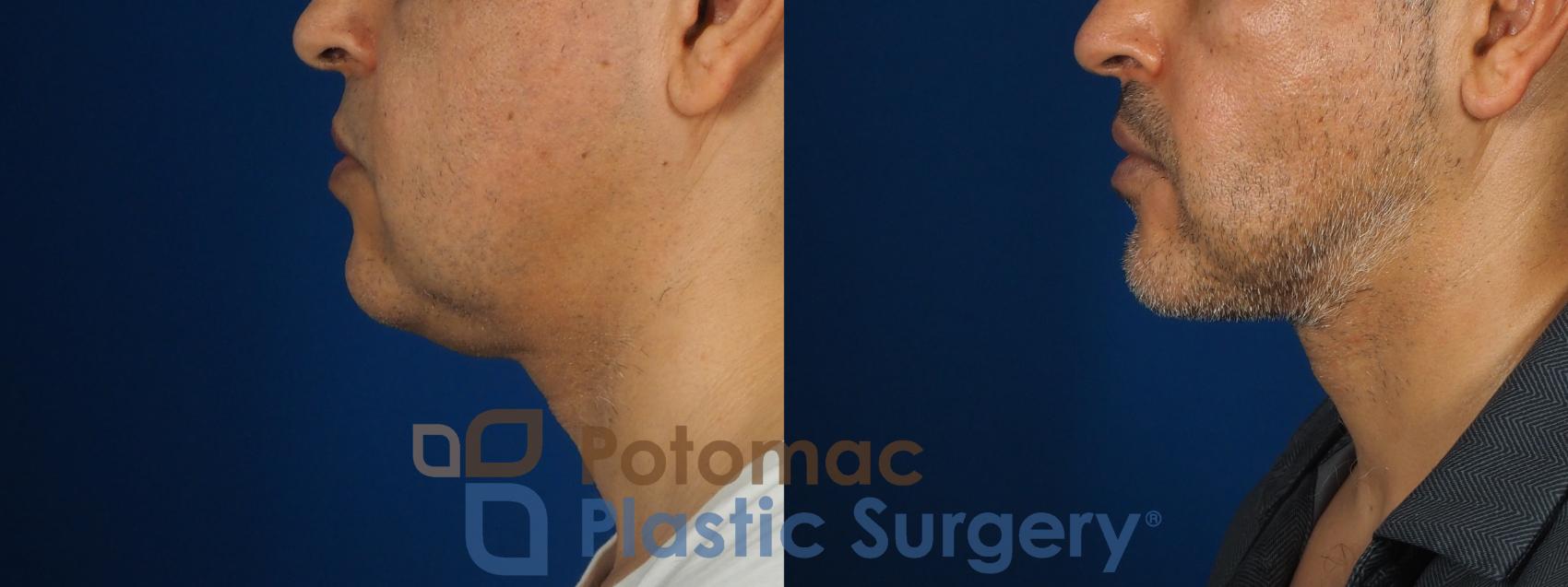 Before & After Buccal Fat Reduction Case 238 Left Side View in Washington DC & Arlington , DC