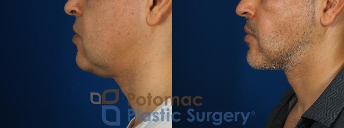 Before & After Neck Lift Case 238 Left Side View in Washington, DC