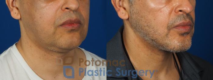 Before & After Neck Lift Case 238 Right Oblique View in Washington, DC