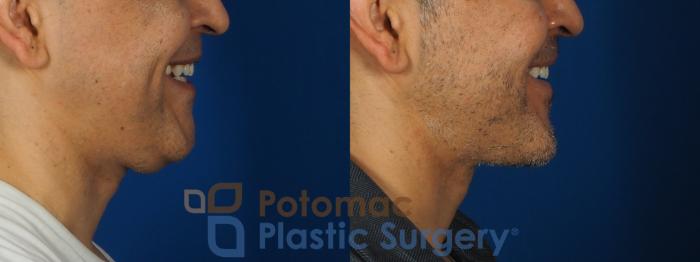 Before & After Neck Lift Case 238 Right Side - Smiling View in Washington, DC