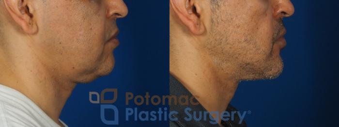 Before & After Neck Lift Case 238 Right Side View in Washington, DC