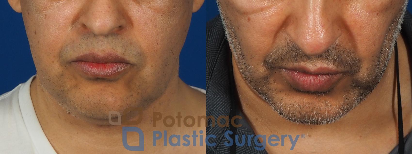 Before & After Neck Lift Case 238 Top View in Washington, DC