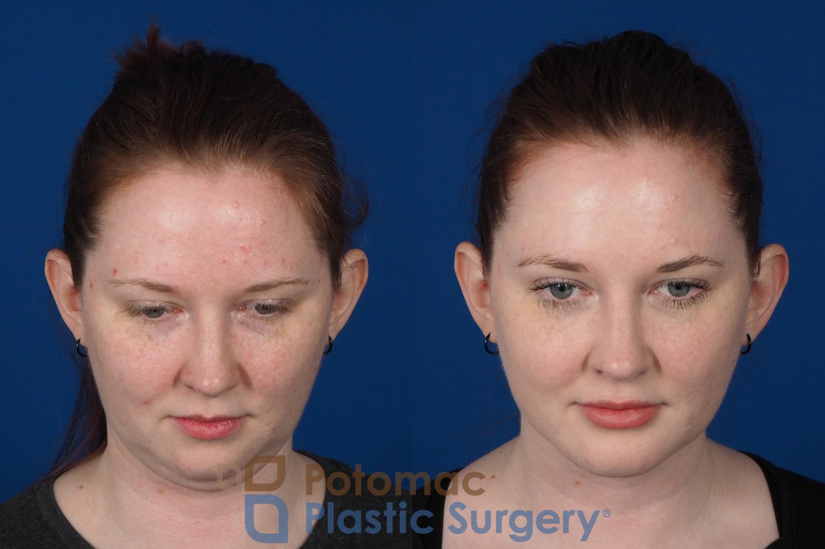Before & After Neck Lift Case 251 Above View in Washington, DC