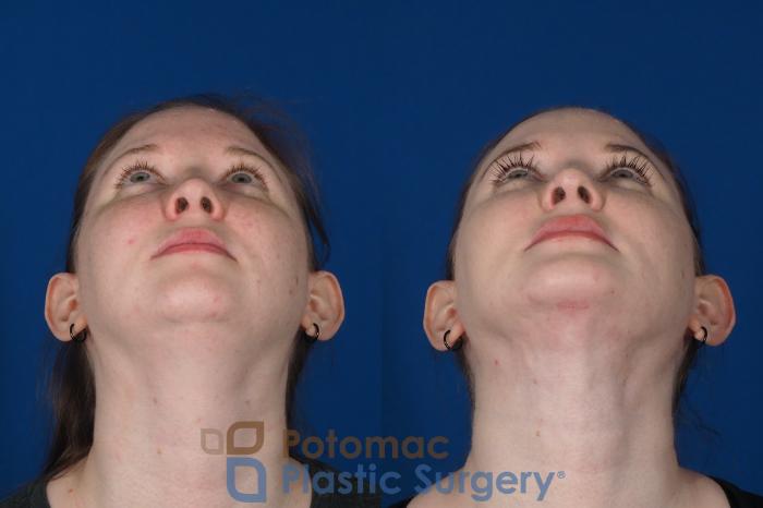 Before & After Chin Augmentation Case 251 Below View in Washington DC & Arlington , DC