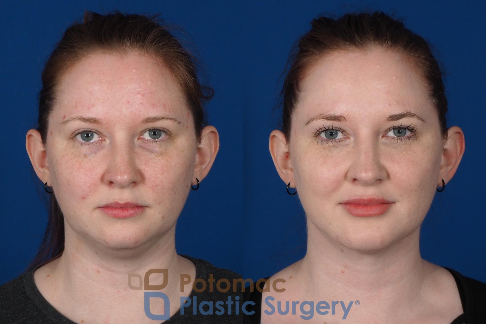 Before & After Liquid Facelift Case 251 Front View #1 View in Washington DC & Arlington , DC