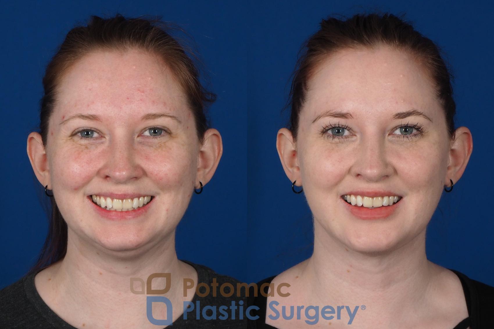 Before & After Neck Lift Case 251 Front View #2 View in Washington, DC