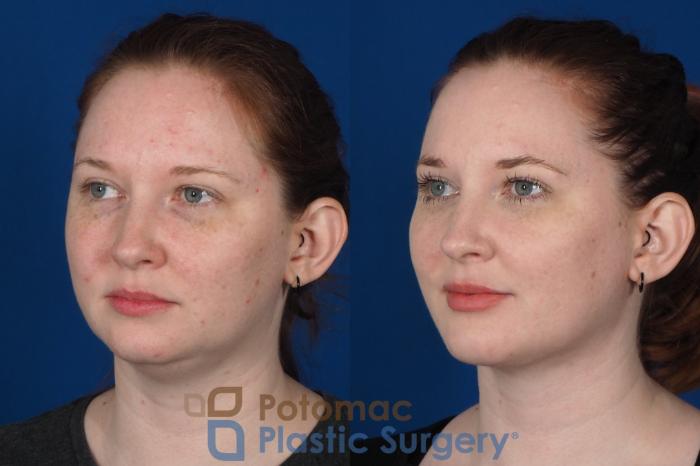Before & After Chin Augmentation Case 251 Left Oblique View in Washington DC & Arlington , DC
