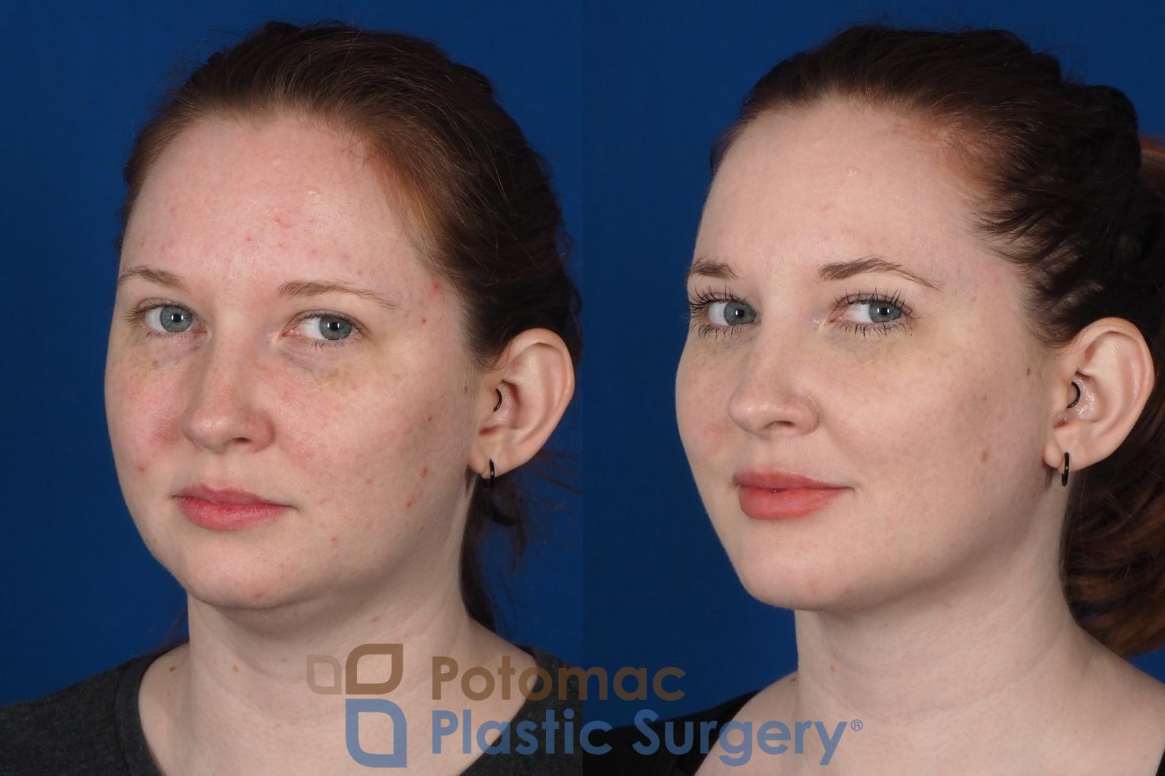 Before & After Neck Lift Case 251 Left Oblique View #2 View in Washington, DC