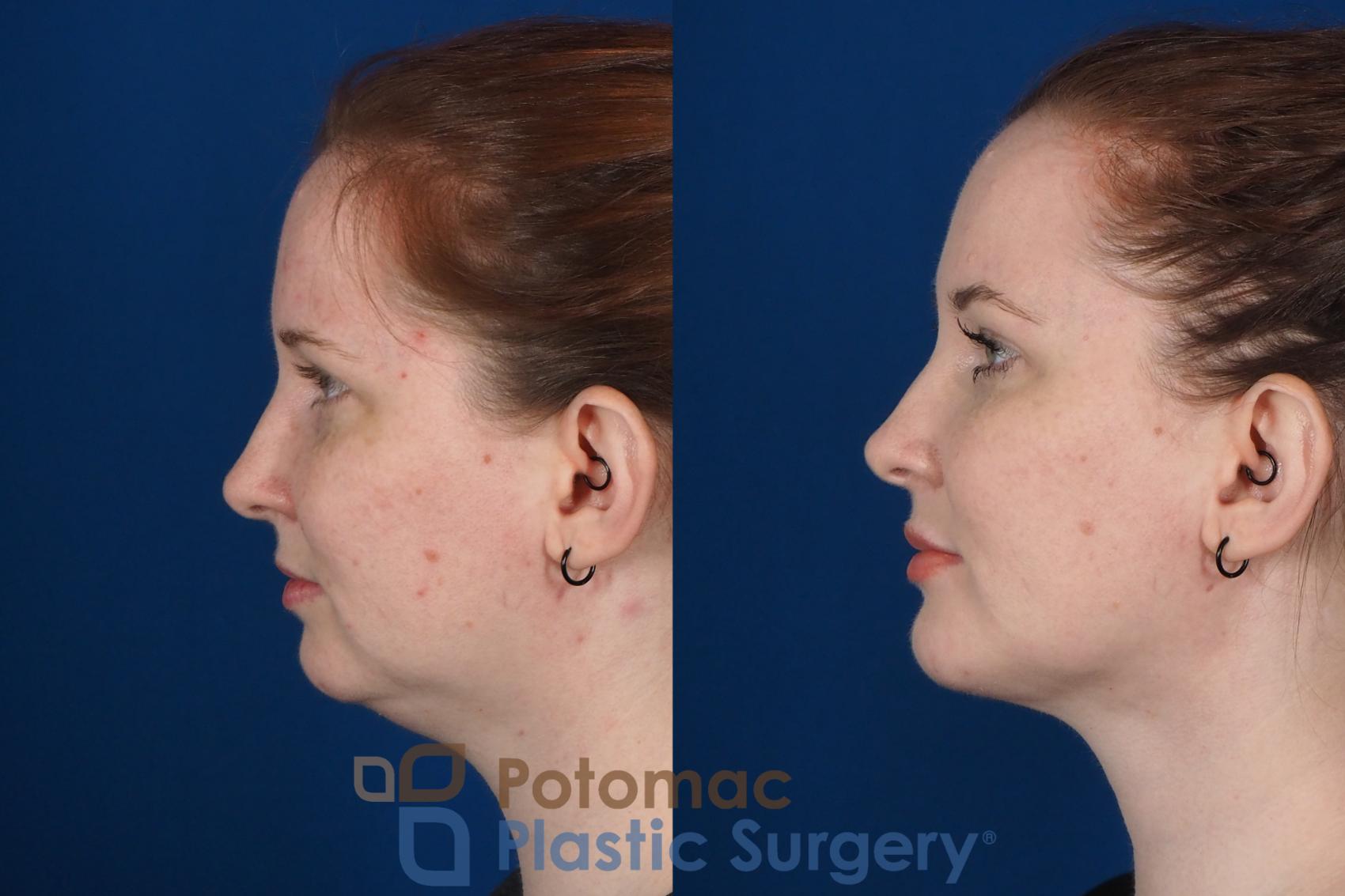 Before & After Neck Lift Case 251 Left Side View in Washington, DC