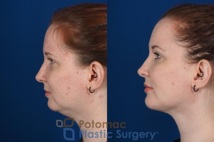 Before & After Chin Augmentation Case 251 Left Side View in Washington DC & Arlington , DC