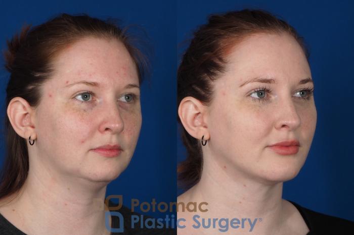 Before & After Chin Augmentation Case 251 Right Oblique View in Washington DC & Arlington , DC