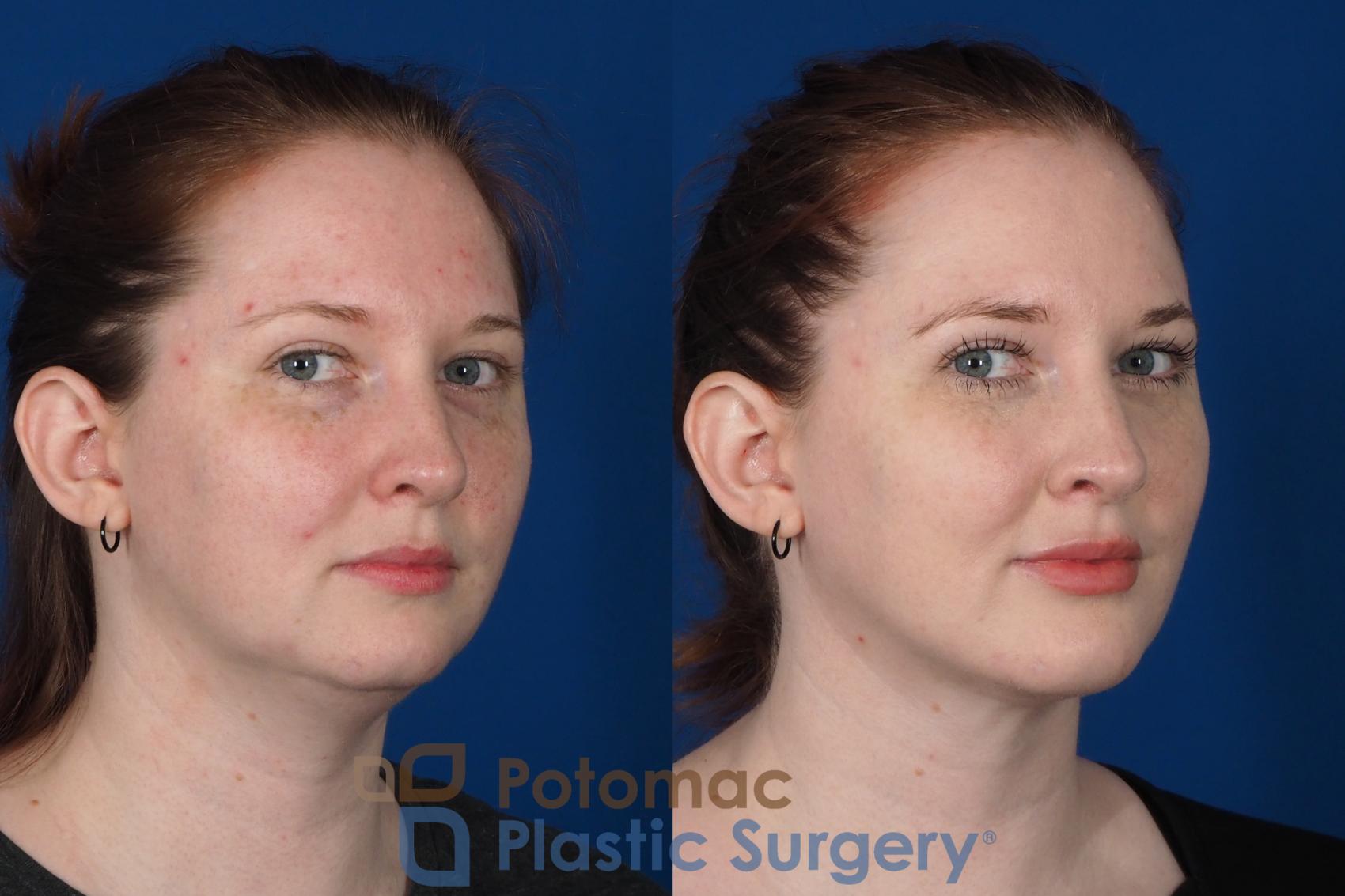 Before & After Neck Lift Case 251 Right Oblique View #2 View in Washington, DC