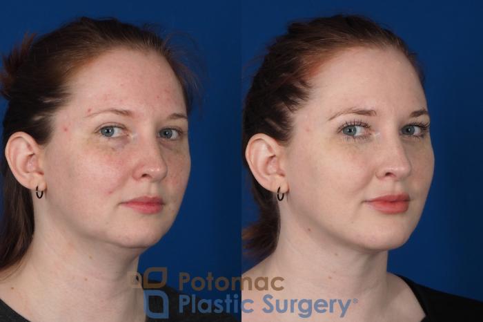 Before & After Lip Augmentation Case 251 Right Oblique View #2 View in Washington DC & Arlington , DC