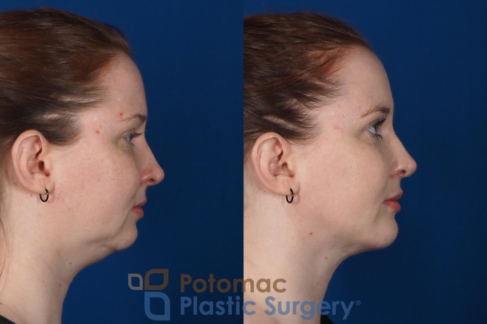 Before & After Neck Lift Case 251 Right Side View in Washington, DC