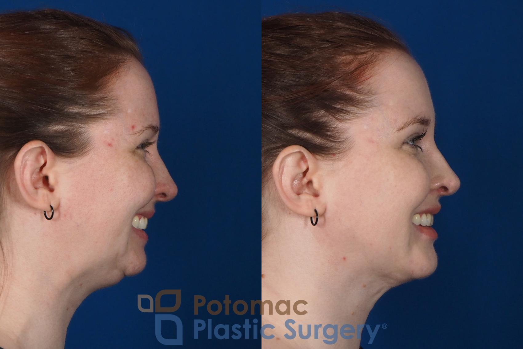 Before & After Neck Lift Case 251 Right Side View #2 View in Washington, DC