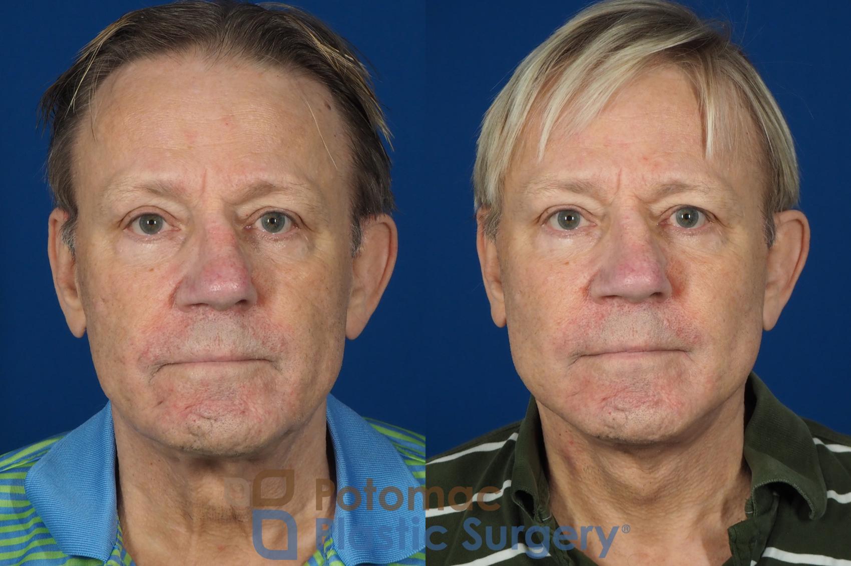 Before & After Neck Lift Case 259 Front View #1 View in Washington DC & Arlington , DC