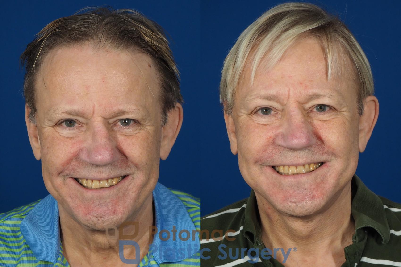 Before & After Neck Lift Case 259 Front View #2 View in Washington DC & Arlington , DC