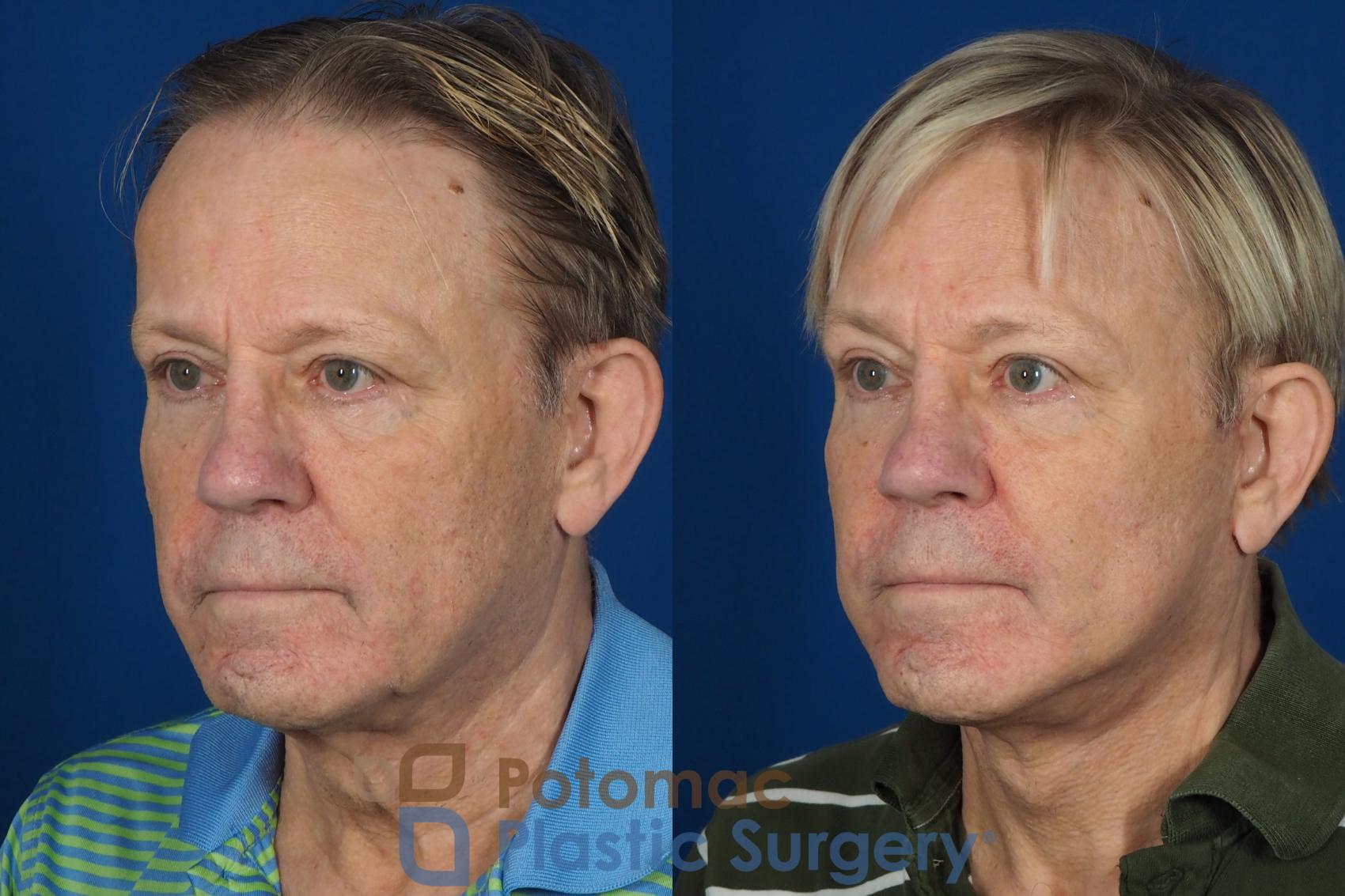 Before & After Neck Lift Case 259 Left Oblique View in Washington DC & Arlington , DC