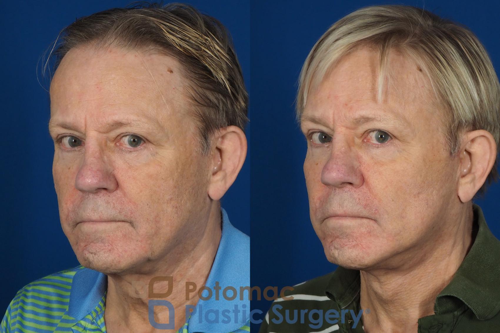 Before & After Neck Lift Case 259 Left Oblique View #2 View in Washington DC & Arlington , DC