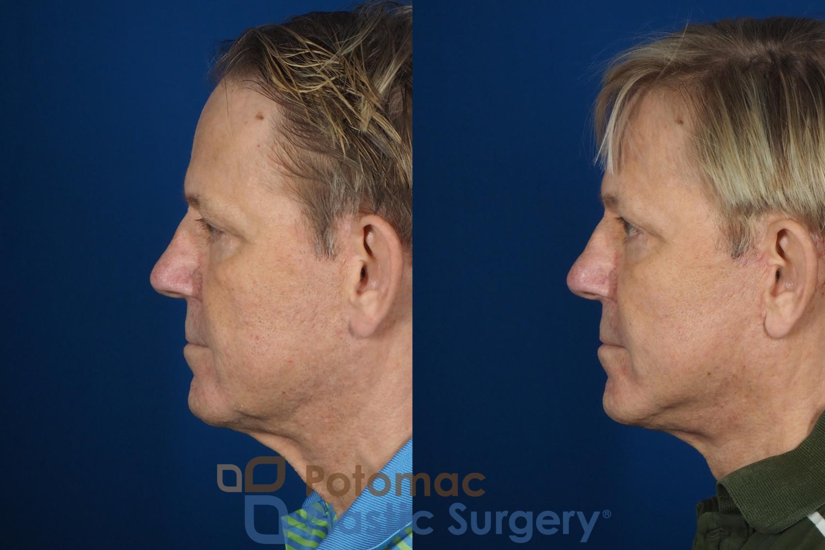 Before & After Neck Lift Case 259 Left Side View in Washington DC & Arlington , DC