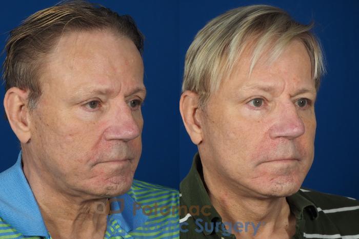 Before & After Facelift Case 259 Right Oblique View in Washington DC & Arlington , DC