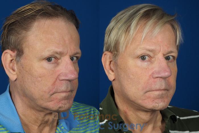 Before & After Facelift Case 259 Right Oblique View #2 View in Washington DC & Arlington , DC