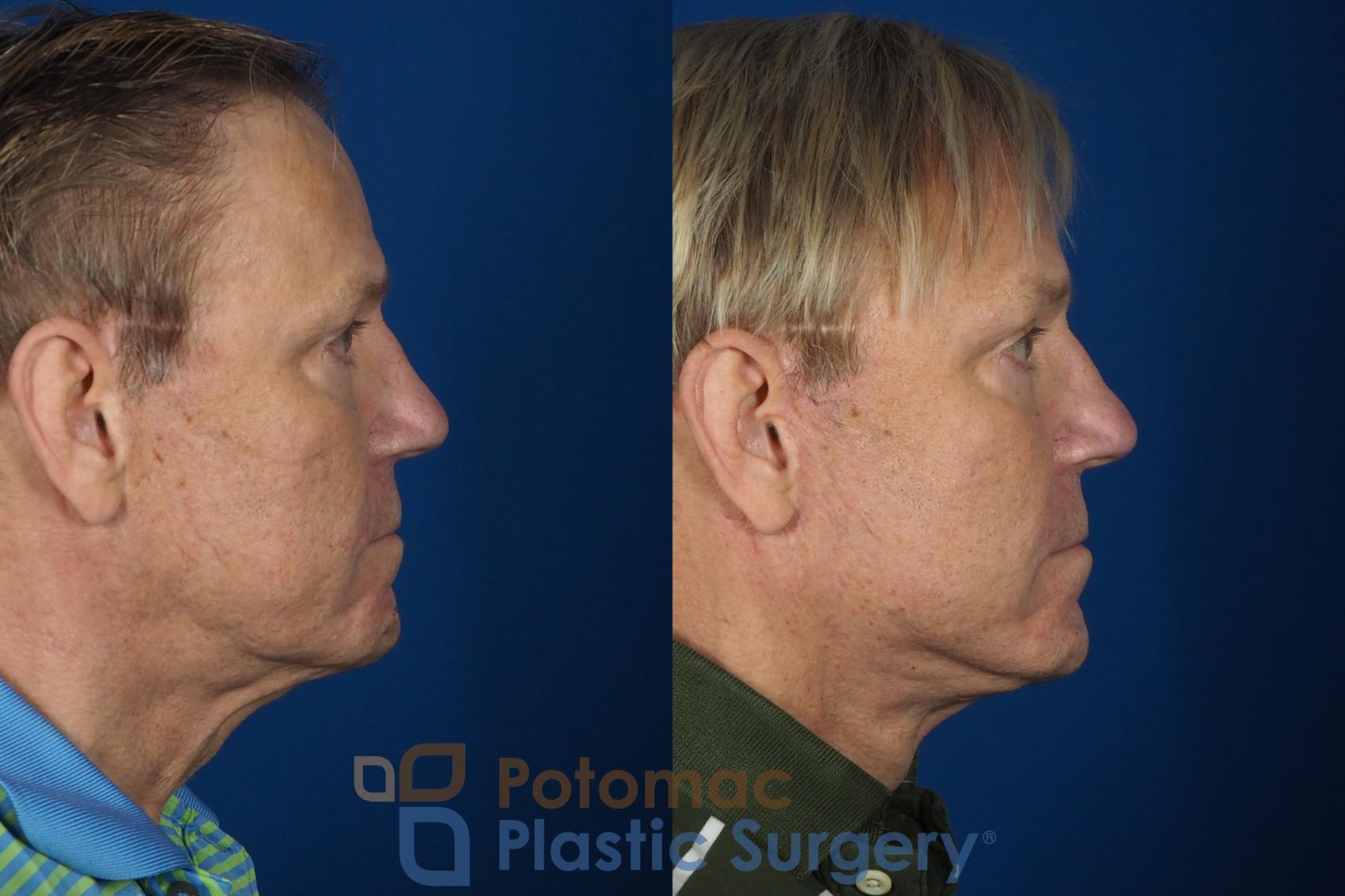 Before & After Neck Lift Case 259 Right Side View in Washington DC & Arlington , DC