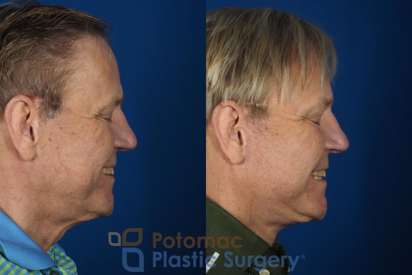 Before & After Neck Lift Case 259 Right Side View #2 View in Washington DC & Arlington , DC