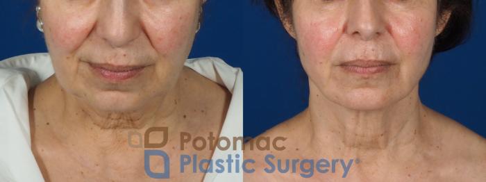 Before & After Neck Lift Case 269 Above View in Washington DC & Arlington , DC