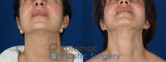 Before & After Facelift Case 269 Below View in Washington DC & Arlington , DC