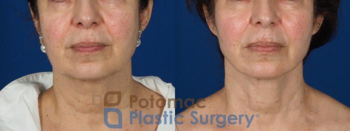 Before & After Neck Lift Case 269 Front View #1 View in Washington DC & Arlington , DC