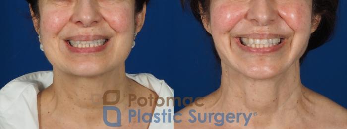 Before & After Neck Lift Case 269 Front View #2 View in Washington DC & Arlington , DC