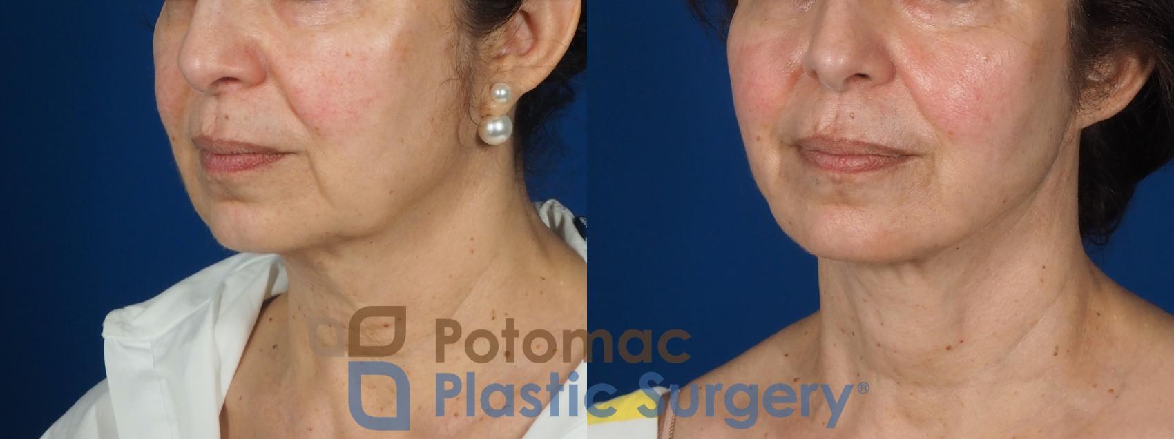 Before & After Fat Transfer Case 269 Left Oblique View in Washington DC & Arlington , DC