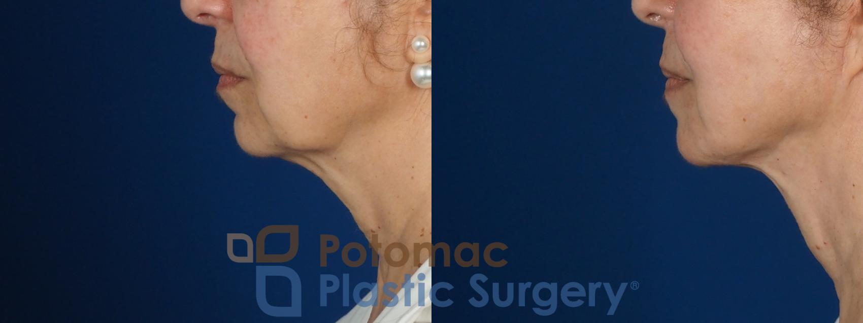 Before & After Fat Transfer Case 269 Left Side View in Washington DC & Arlington , DC