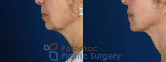 Before & After Facial Sculpting Case 269 Left Side View in Washington DC & Arlington , DC