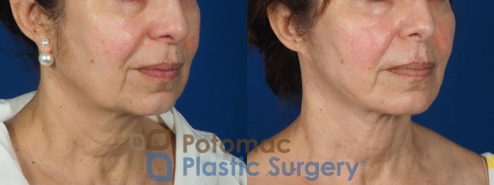 Before & After Facial Sculpting Case 269 Right Oblique View in Washington DC & Arlington , DC