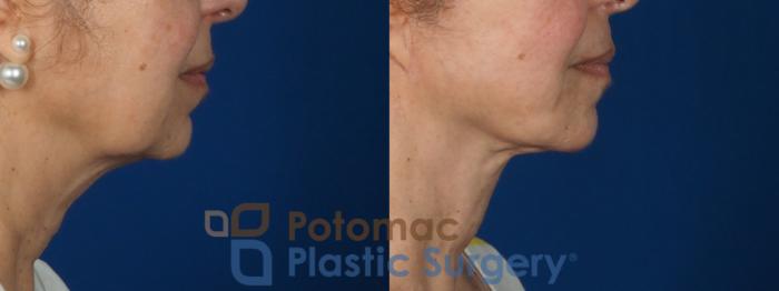 Before & After Facelift Case 269 Right Side View in Washington DC & Arlington , DC