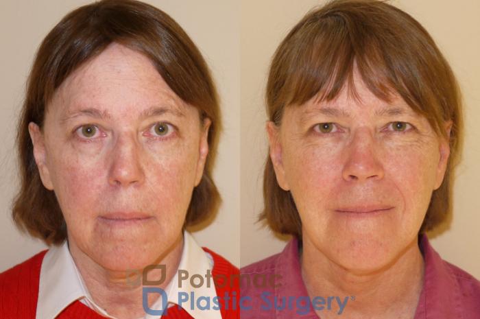 Before & After Neck Lift Case 45 Front View in Washington DC & Arlington , DC