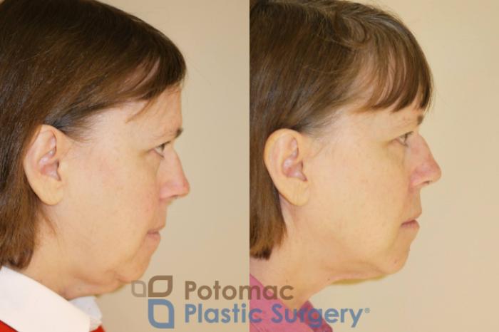 Before & After Neck Lift Case 45 Right Side View in Washington DC & Arlington , DC