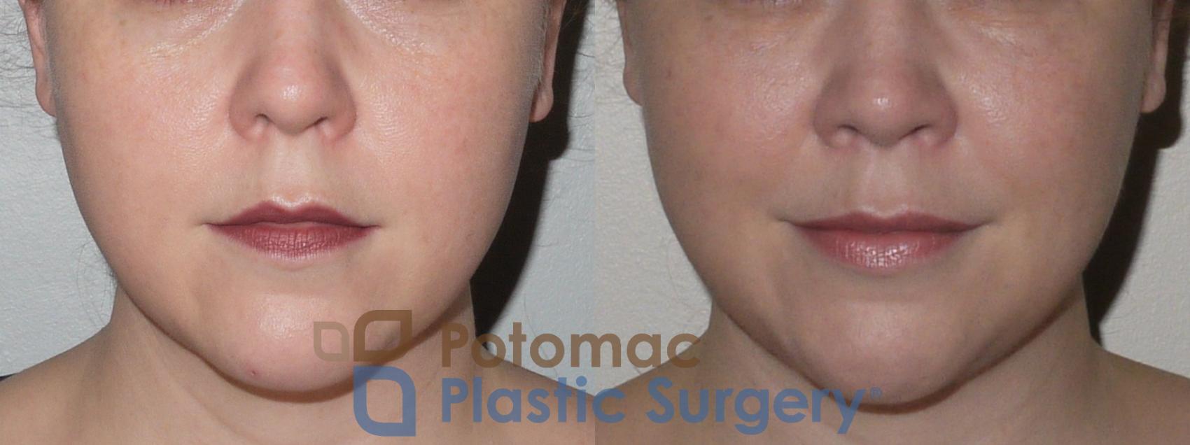 Before & After Liposuction Case 87 Front View in Washington, DC